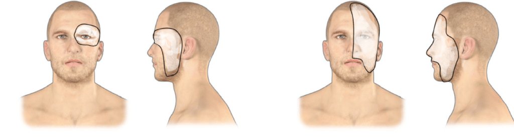 vitiligo treatment before/after images in Hyderabad